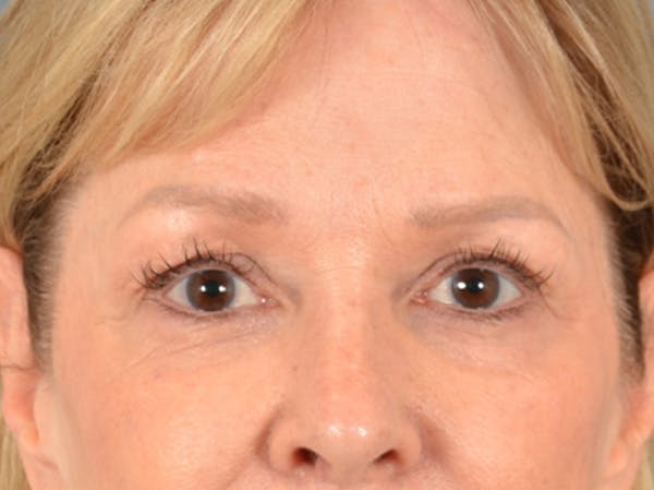 Brow Lift Before & After Gallery - Patient 176282 - Image 1