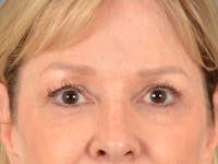 Eyelid Lift Before & After Gallery - Patient 133559 - Image 1