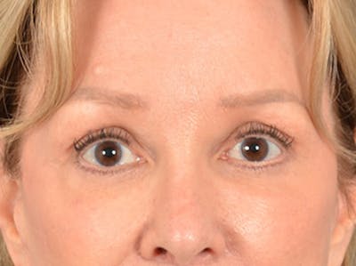 Brow Lift Before & After Gallery - Patient 176282 - Image 2