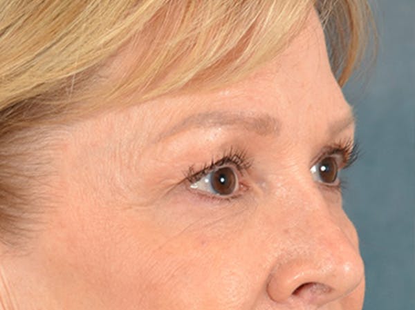 Brow Lift Before & After Gallery - Patient 176282 - Image 3