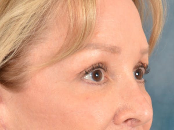Brow Lift Before & After Gallery - Patient 176282 - Image 4