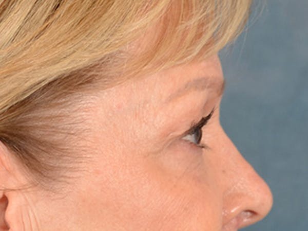 Eyelid Lift Before & After Gallery - Patient 133559 - Image 5