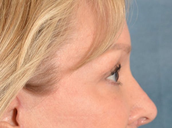Eyelid Lift Before & After Gallery - Patient 133559 - Image 6