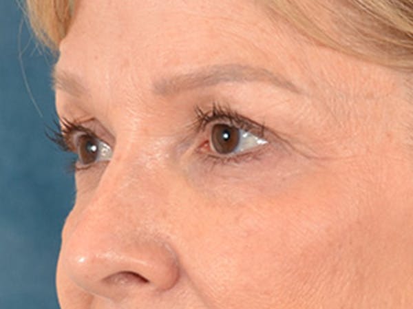 Brow Lift Before & After Gallery - Patient 176282 - Image 7