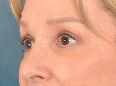Brow Lift Before & After Gallery - Patient 176282 - Image 8