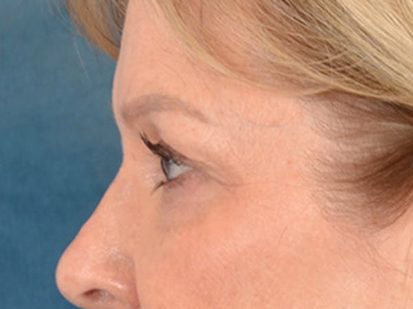 Brow Lift Before & After Gallery - Patient 176282 - Image 9