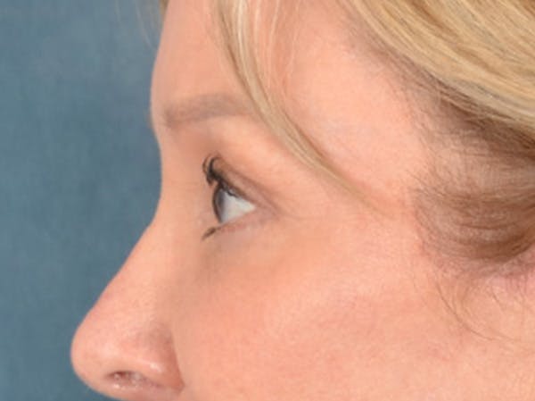 Brow Lift Before & After Gallery - Patient 176282 - Image 10