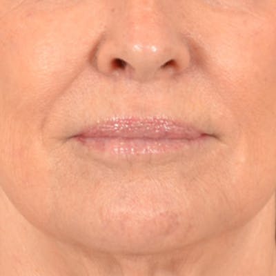 Lip Lift Before & After Gallery - Patient 419416 - Image 1