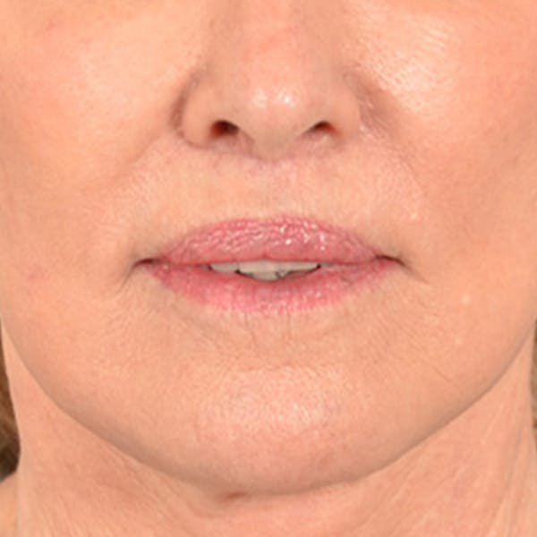 Lip Lift Before & After Gallery - Patient 419416 - Image 2