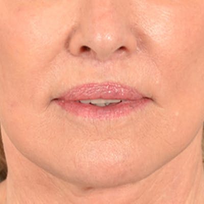 Lip Lift Before & After Gallery - Patient 419416 - Image 2