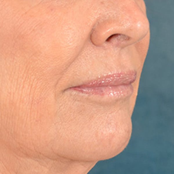 Lip Lift Before & After Gallery - Patient 419416 - Image 3