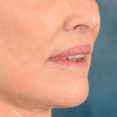 Lip Lift Before & After Gallery - Patient 419416 - Image 4