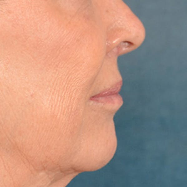 Lip Lift Before & After Gallery - Patient 419416 - Image 5