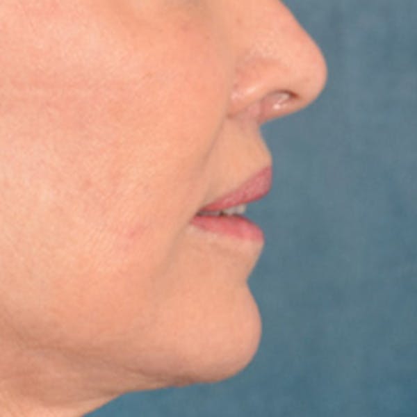 Lip Lift Before & After Gallery - Patient 419416 - Image 6