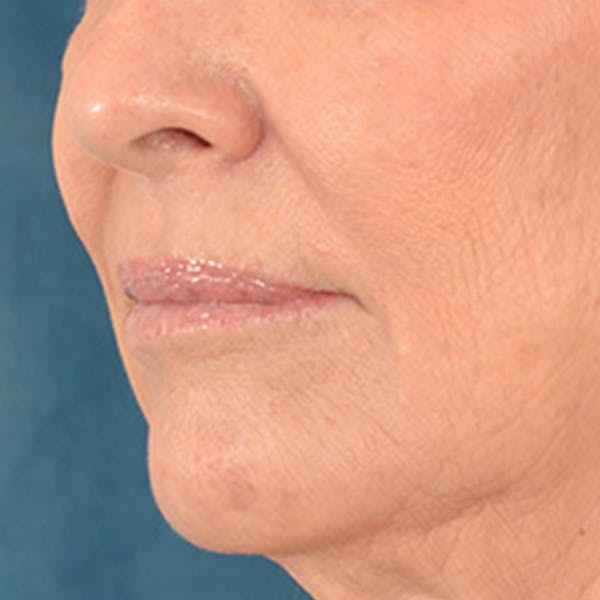 Lip Lift Before & After Gallery - Patient 419416 - Image 7