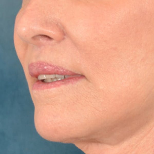 Lip Lift Before & After Gallery - Patient 419416 - Image 8