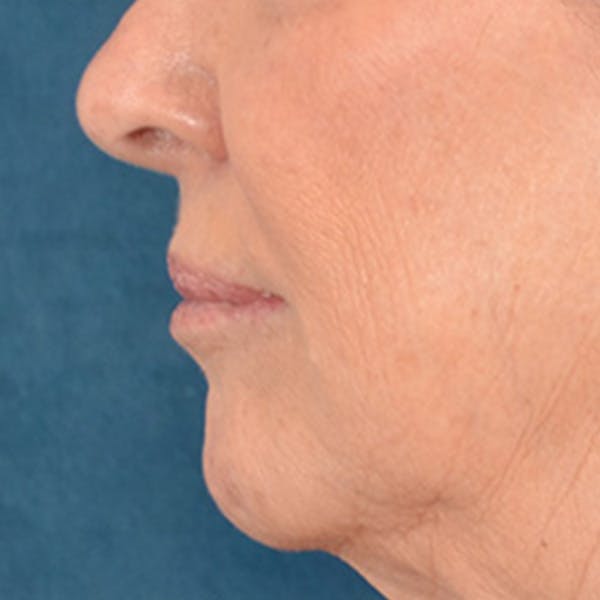 Lip Lift Before & After Gallery - Patient 419416 - Image 9