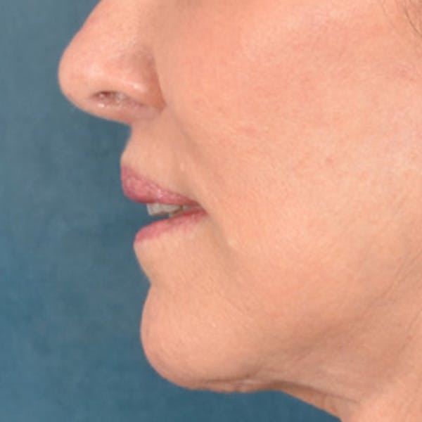 Lip Lift Before & After Gallery - Patient 419416 - Image 10