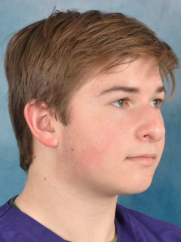 Rhinoplasty Before & After Gallery - Patient 535868 - Image 7