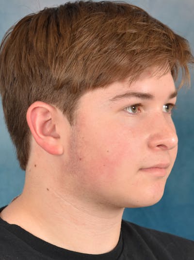 Rhinoplasty Before & After Gallery - Patient 535868 - Image 8
