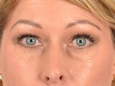 Brow Lift Before & After Gallery - Patient 126639 - Image 1