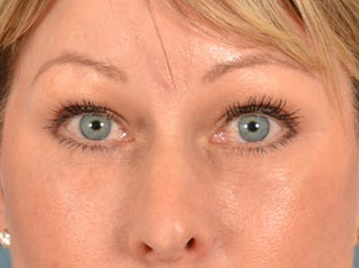 Eyelid Lift Before & After Gallery - Patient 117607 - Image 2