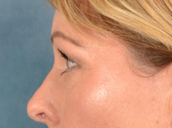 Brow Lift Before & After Gallery - Patient 126639 - Image 5