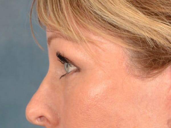 Eyelid Lift Before & After Gallery - Patient 117607 - Image 6