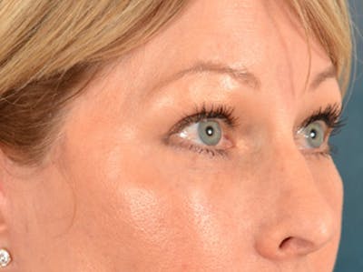 Brow Lift Before & After Gallery - Patient 126639 - Image 8