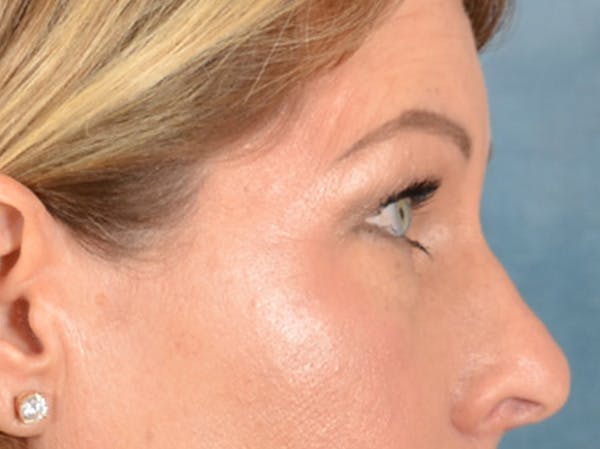 Brow Lift Before & After Gallery - Patient 126639 - Image 9