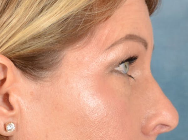 Brow Lift Before & After Gallery - Patient 126639 - Image 9