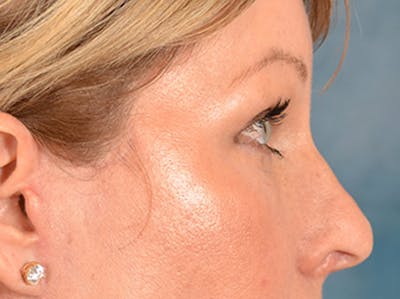 Brow Lift Before & After Gallery - Patient 126639 - Image 10