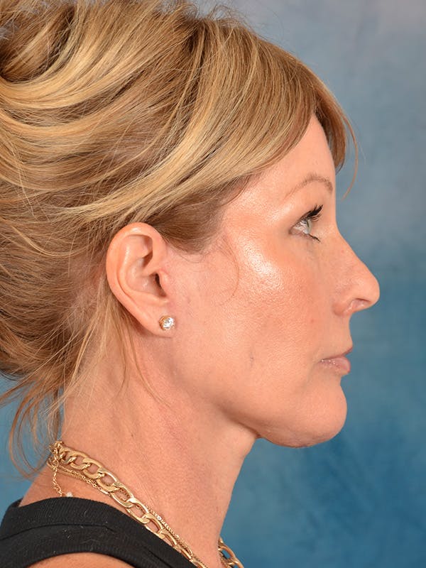Deep Plane Facelift Before & After Gallery - Patient 281252 - Image 8