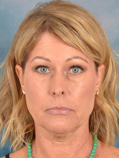 Laser Skin Resurfacing Before & After Gallery - Patient 344196 - Image 1