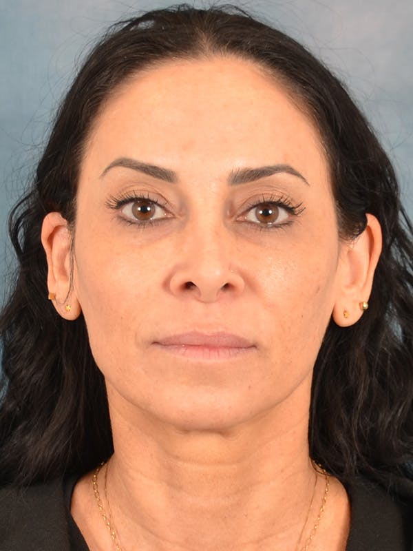 Laser Skin Resurfacing Before & After Gallery - Patient 763737 - Image 1