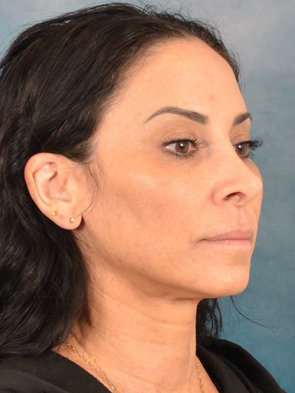 Deep Plane Facelift Before & After Gallery - Patient 119013 - Image 7