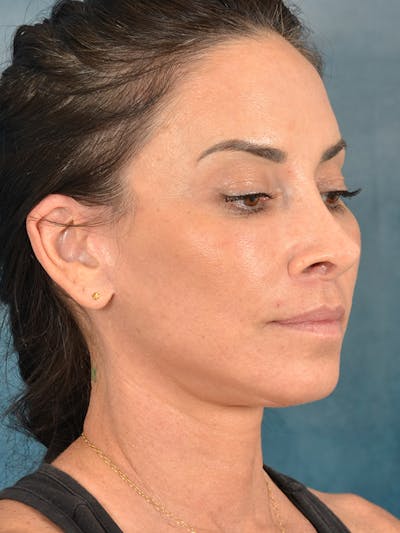 Deep Plane Facelift Before & After Gallery - Patient 119013 - Image 8