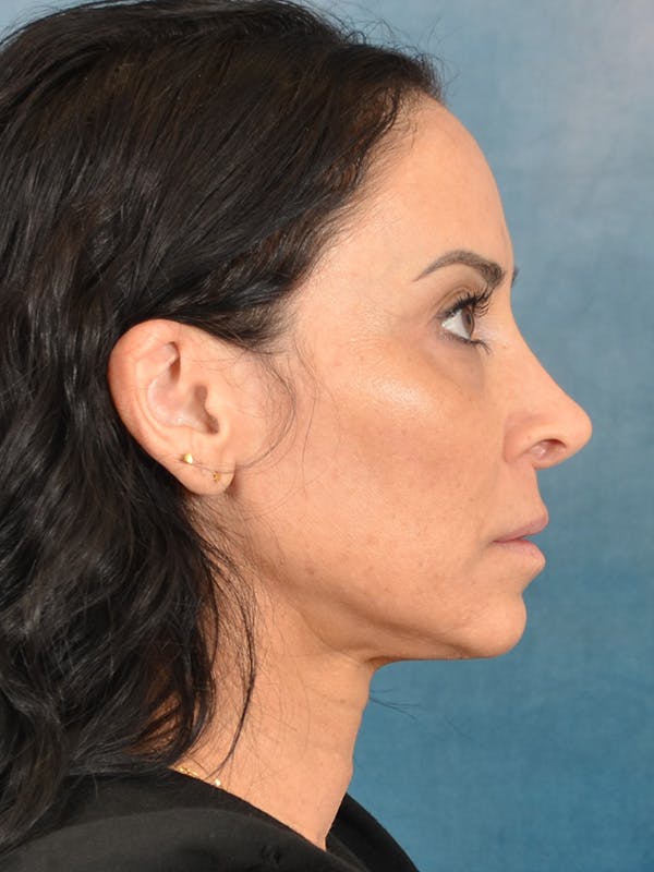 Deep Plane Facelift Before & After Gallery - Patient 119013 - Image 9