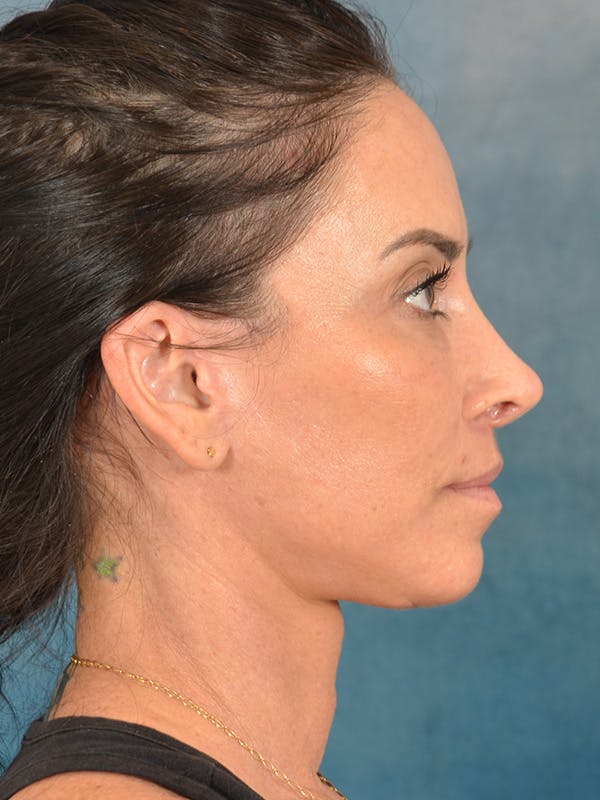 Deep Plane Facelift Before & After Gallery - Patient 119013 - Image 10