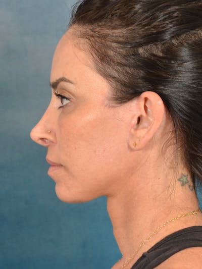Deep Plane Facelift Before & After Gallery - Patient 119013 - Image 4