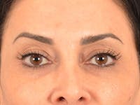 Eyelid Lift Before & After Gallery - Patient 447876 - Image 1