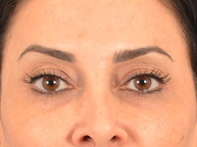 Eyelid Lift Before & After Gallery - Patient 447876 - Image 1