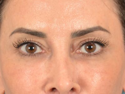 Eyelid Lift Before & After Gallery - Patient 447876 - Image 2
