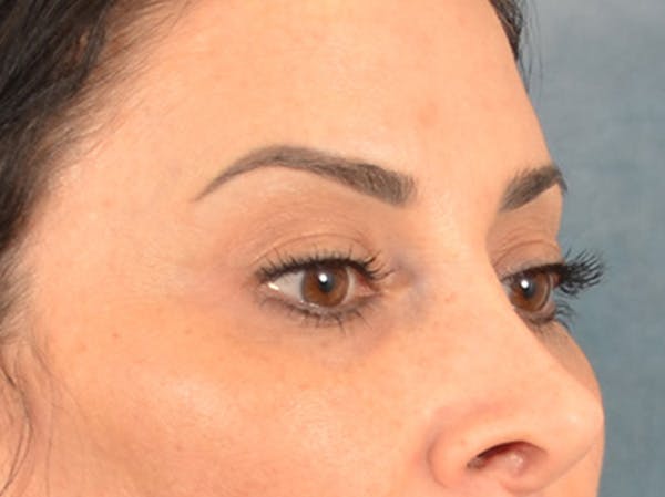 Eyelid Lift Before & After Gallery - Patient 447876 - Image 3