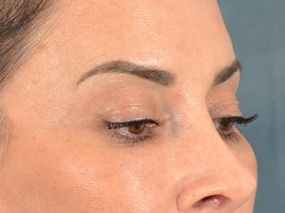 Eyelid Lift Before & After Gallery - Patient 447876 - Image 4