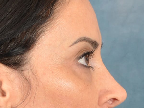 Eyelid Lift Before & After Gallery - Patient 447876 - Image 5