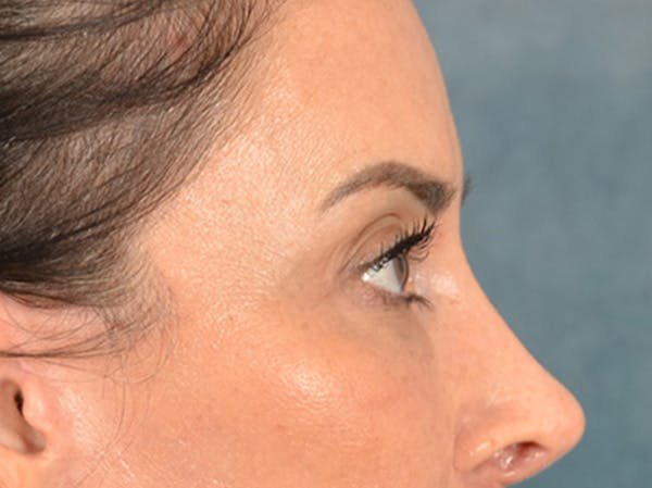 Eyelid Lift Before & After Gallery - Patient 447876 - Image 6
