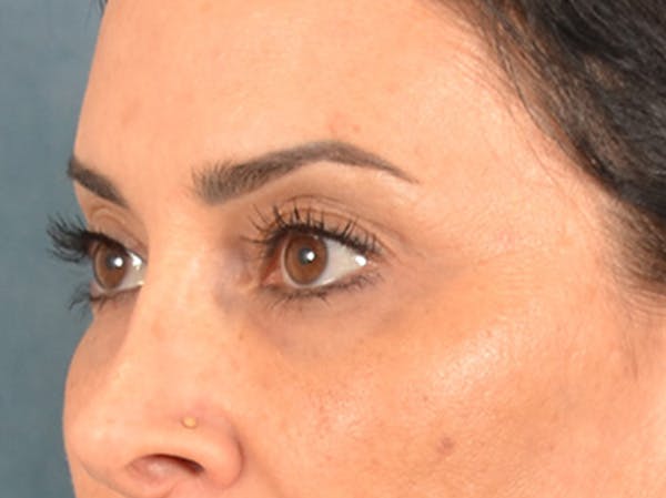 Eyelid Lift Before & After Gallery - Patient 447876 - Image 7