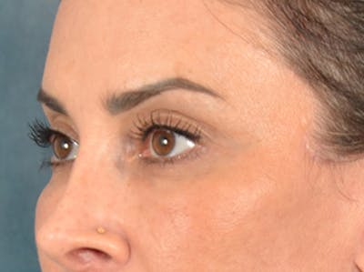 Eyelid Lift Before & After Gallery - Patient 447876 - Image 8