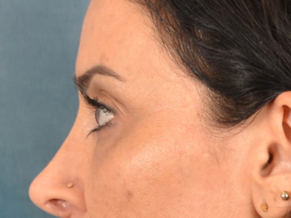 Eyelid Lift Before & After Gallery - Patient 447876 - Image 9